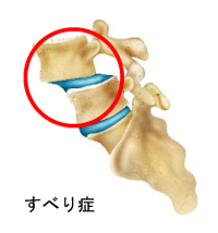 <span>1.</span>腰椎すべり症とは？