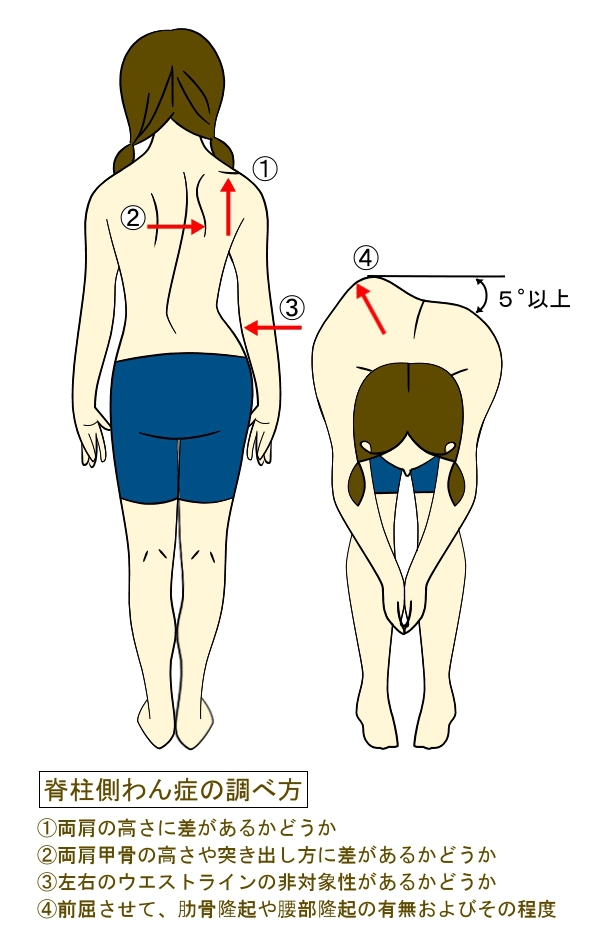 <span>1.</span>あなたの背中の側弯チェック